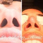 Bulbous Nose Before And After Nose Surgery (2)