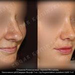 Bulbous Nose Before And After Nose Surgery (3)