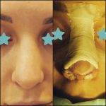 Bulbous Nose Before And After Open Rhinoplasty Photos
