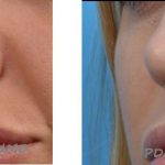 Bulbous Nose Before And After Plastic Surgery For Nose (1)