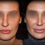 Bulbous Nose Before And After Plastic Surgery For Nose (4)