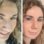 Bulbous Nose Contouring Before And After