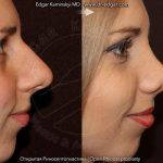 Bulbous Nose Correction Before And After