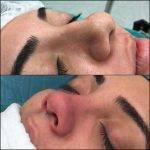 Bulbous Nose Is One Of The More Common Reasons That Patients Seek Rhinoplasty