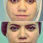 Bulbous Nose Job Before And After