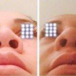 Bulbous Nose Job Before And After Photos