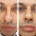 Bulbous Nose Job For Man Before After Photos