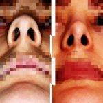 Bulbous Nose Reduction Preop And Postop Photos