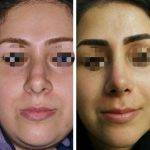 Bulbous Nose Rhinoplasty Before And After Photos