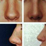 Bulbous Nose Rhinoplasty Before And After Pictures