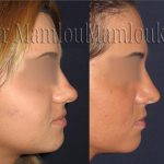Bulbous Nose Rhinoplasty Preop And Post Op (1)