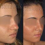 Bulbous Nose Rhinoplasty Preop And Post Op (2)