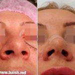 Bulbous Nose Rhinoplasty Preop And Post Op (3)