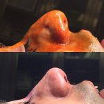 Bulbous Nose Rhinoplasty Preop And Post Op (4)