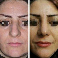 Bulbous Nose Surgery Before And After Photos