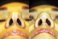 Bulbous Nose Surgery Photos