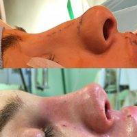 Bulbous Nose Tip Before And After