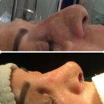 Bulbous Nose Tip Surgery Before And After