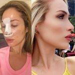 Bulbous Rhinoplasty Before And After