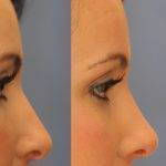 Bulbous Tip Nose Before And After Nose Reshaping