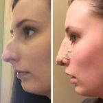 Cold Compresses May Help Reduce Swelling After Nose Job