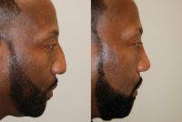 Correction Of Profile-hump, And Wide Appearance By Dr Eric M Joseph