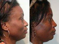 Cosmetic Nose Job To Reduce Wide Nostrils In The African American Rhinoplasty Patient