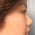 Cosmetic Nose Surgery Necessitates Advanced Training And Experience In Rhinoplasty