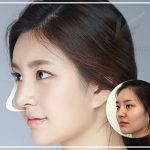 Cosmetic Surgery For Asian Nose To Augment The Bridge And Thereby Improve The Profile And Create Better Definition