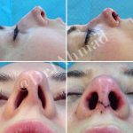 Crooked Nose Bone Treatment