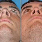 Crooked Nose How To Fix With Rhinoplasty