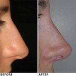 Crooked Nose Images