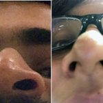 Crooked Nose In Pictures (3)
