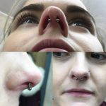 Crooked Nose Rhinoplasty Before After (2)