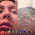 Crooked Nose Rhinoplasty Before After (3)