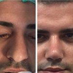 Crooked Noses Can Be Restored To A Relatively Normal Alignment And Shape