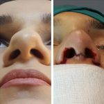 Deviated Septum Before And After (3)