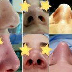 Deviated Septum Nose (4)