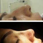 Deviated Septum Nose Job (2)