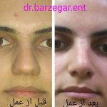 Deviated Septum Nose Job (4)