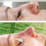 Deviated Septum Nose Job (5)