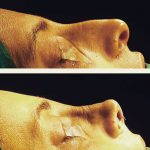 Deviated Septum Nose Job (6)