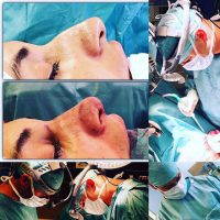Deviated Septum Surgery Is Typically An Outpatient Procedure And Can Be Done Under Either Local Or General Anesthesia