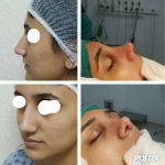 Deviated Septum Surgery Recovery