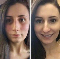 Don't Begin Exercising For 3-4 Weeks After Rhinoplasty