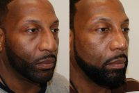 Dr Eric M. Joseph African American Rhinoplasty Before And After Photos
