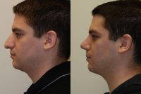 Dr Eric M. Joseph Male Rhinoplasty Before And After Photos