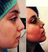 Dr Hamidreza HOSNANI Nasal Rhinoplasty Images Before And After
