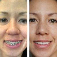 Dr Shervin Naderi Maryland Plastic Surgery Nose Photo