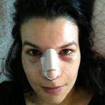 Dr Terrence Scamp Nose Surgery In Gold Coast, Queensland Makes The Nose Smaller